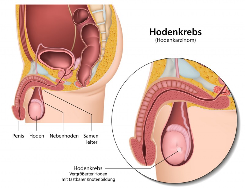 Hodenkrebs