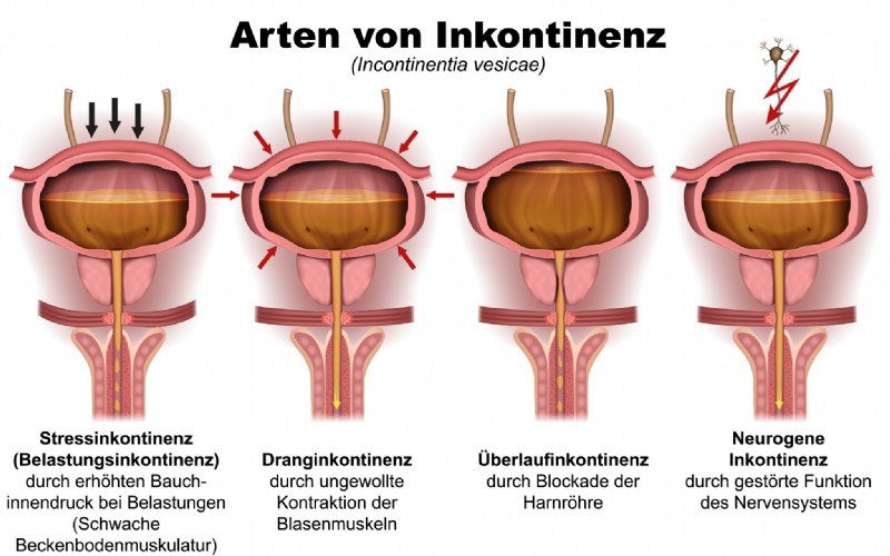 Hilfe bei Inkontinenz