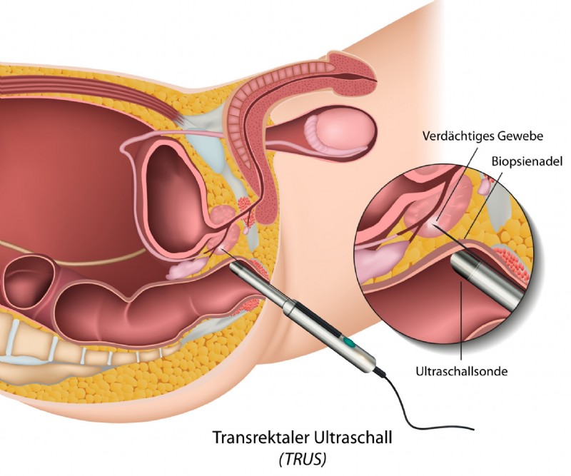 Gewebeentnahme aus der Prostata (Prostatabiopsie)