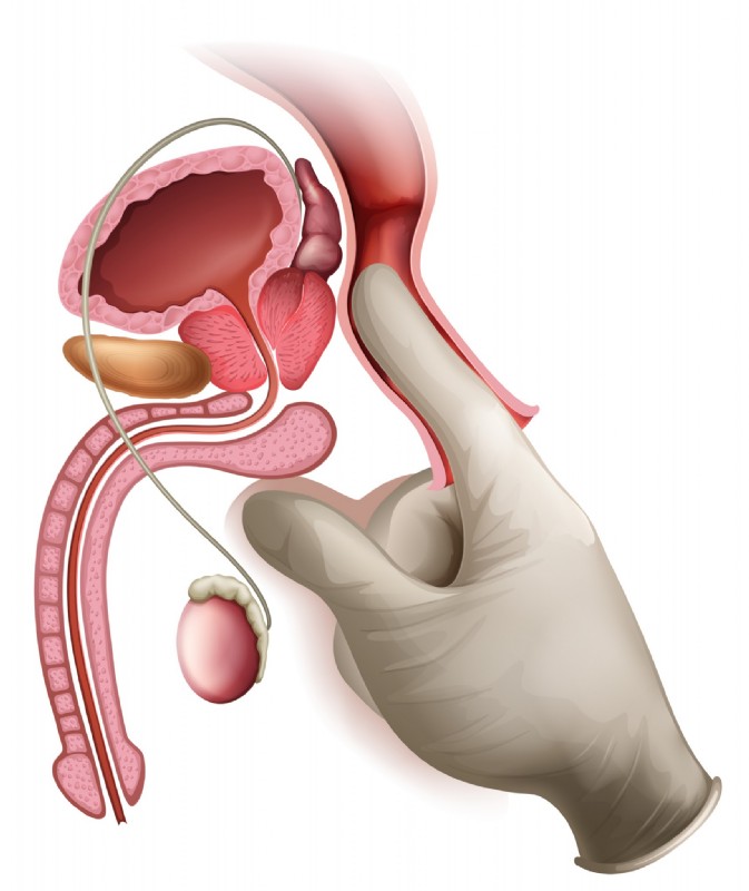 Tastuntersuchung der Prostata