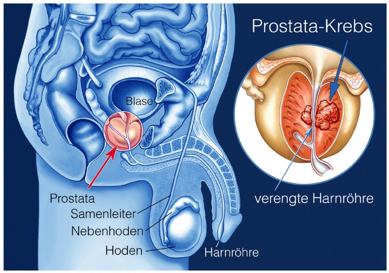 Prostatakrebs